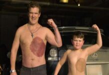 Cánada: Padre se tatua la mancha de nacimiento que acomplejaba a su hijo